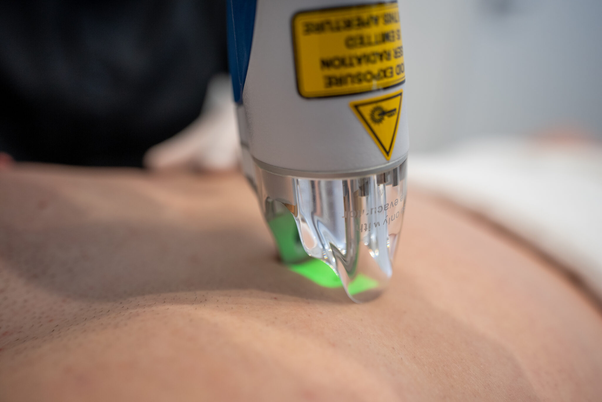 What Does A Male Brazilian Laser Include?